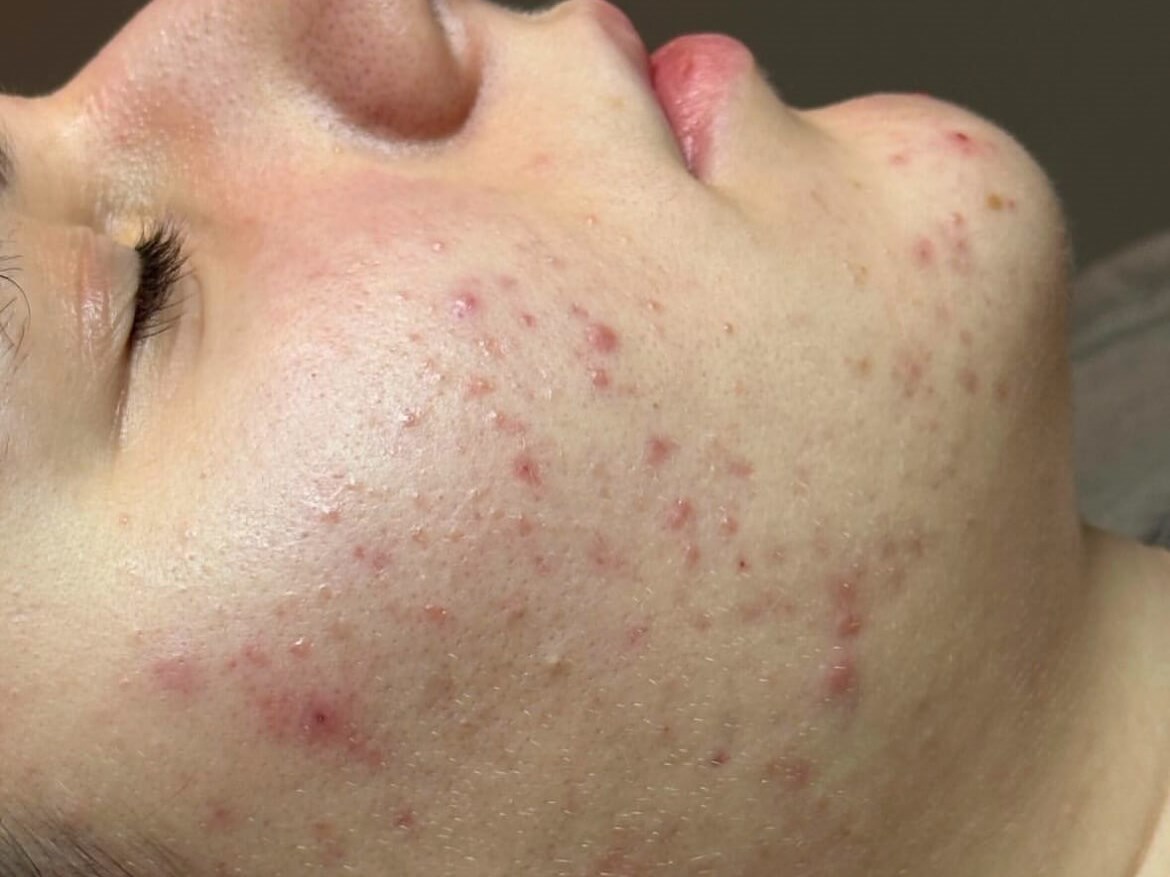 Fix your Rosacea at JEM Before