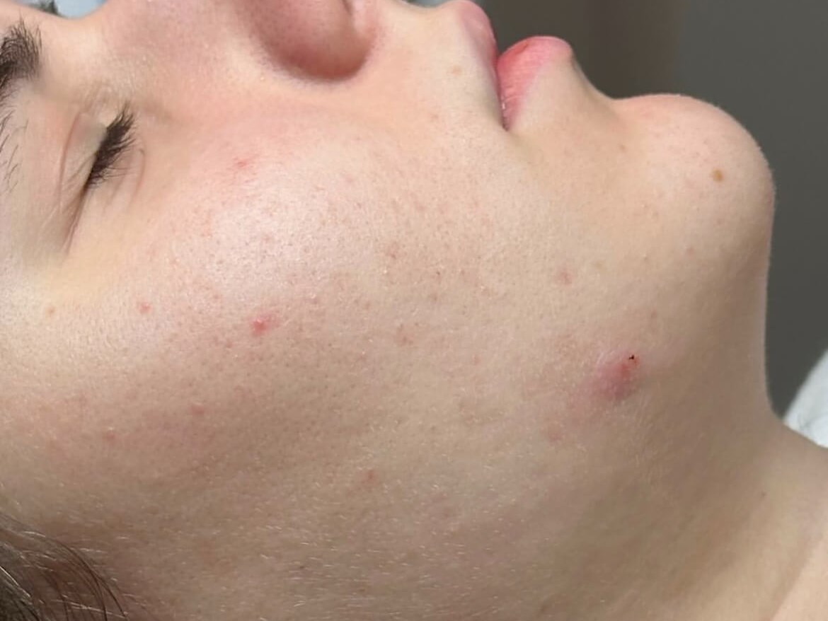 Fix your Rosacea at JEM After