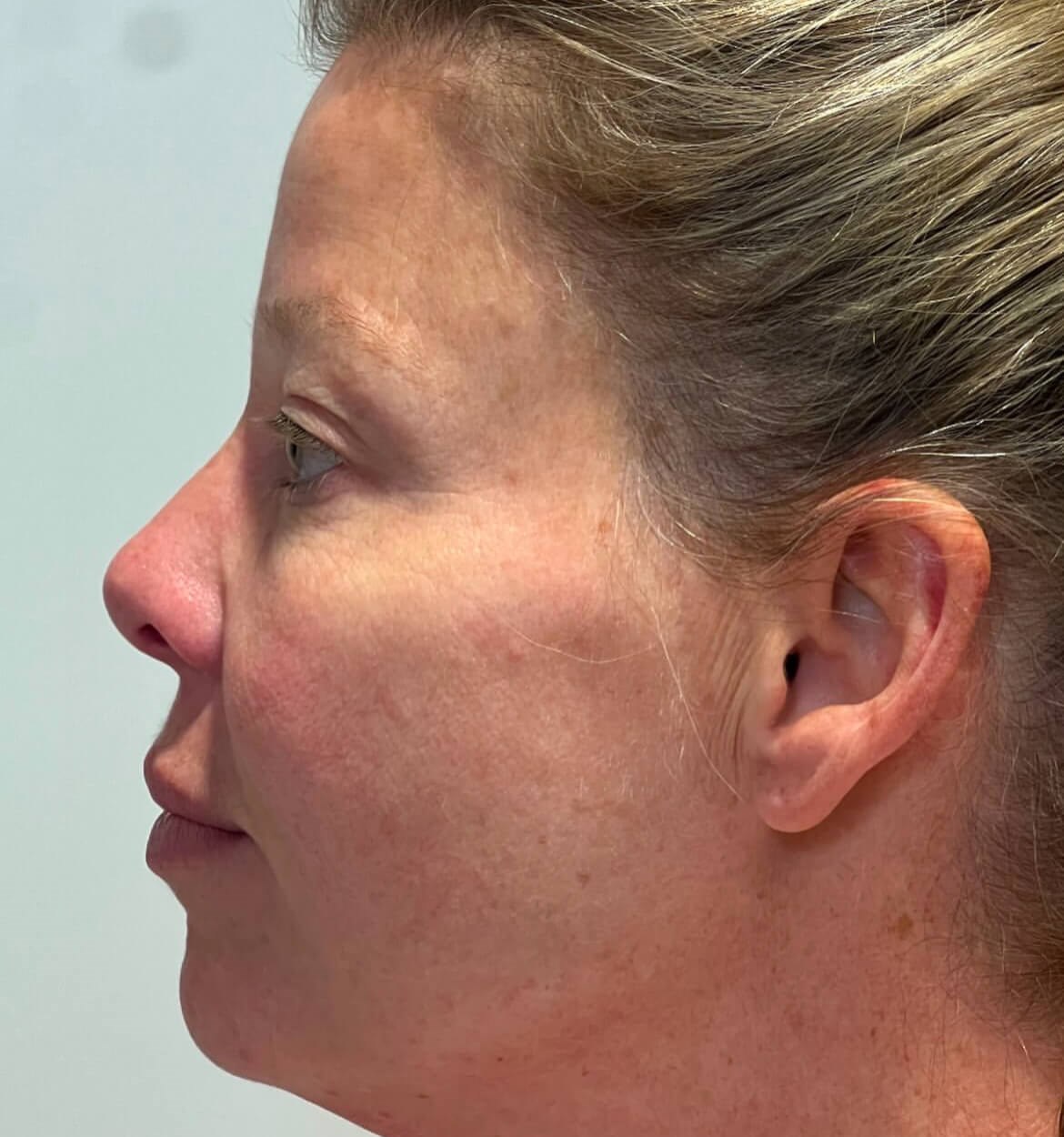 Rejuvenate & Refresh Your Skin After