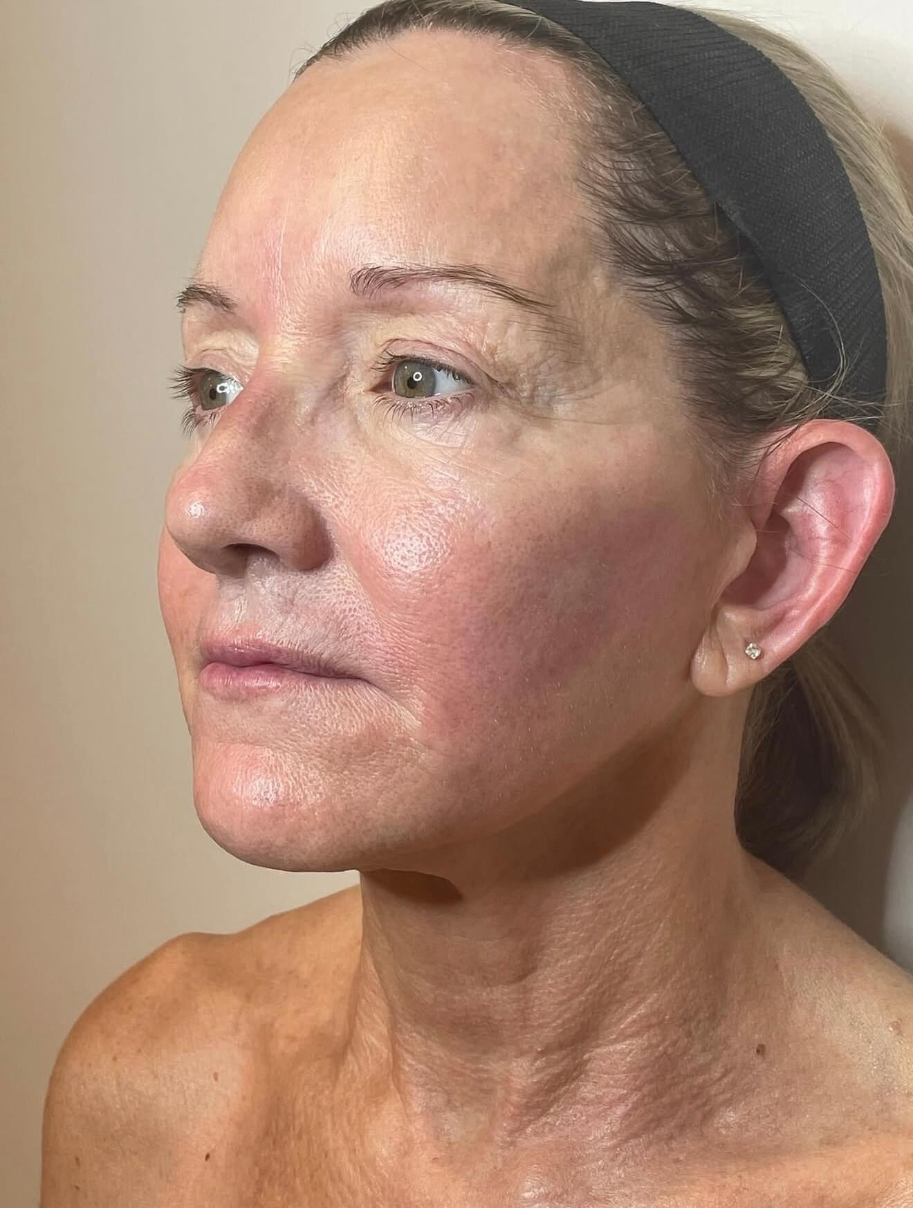 Lift, Tighten & Glow After