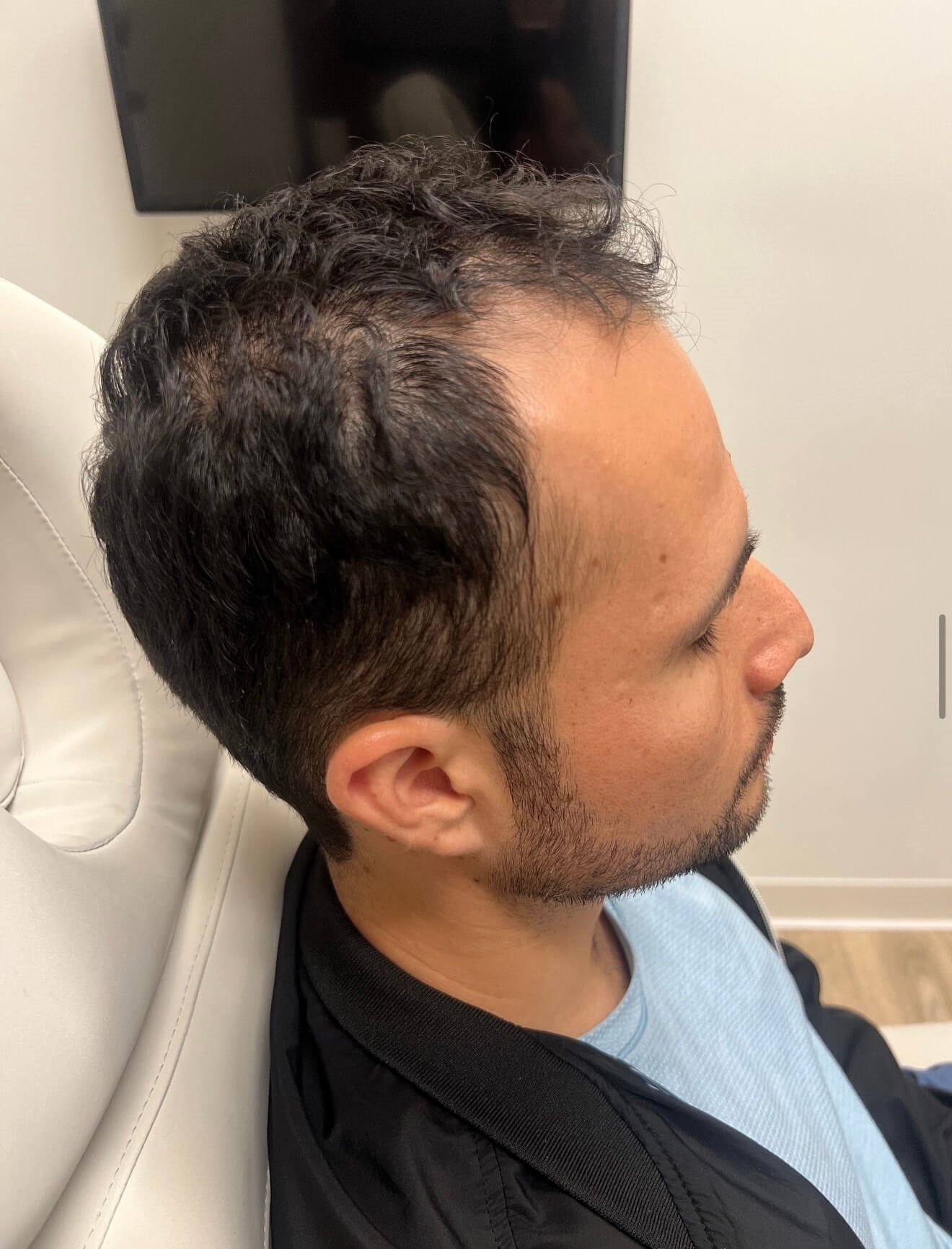 Thicker Hair with Vitti Before