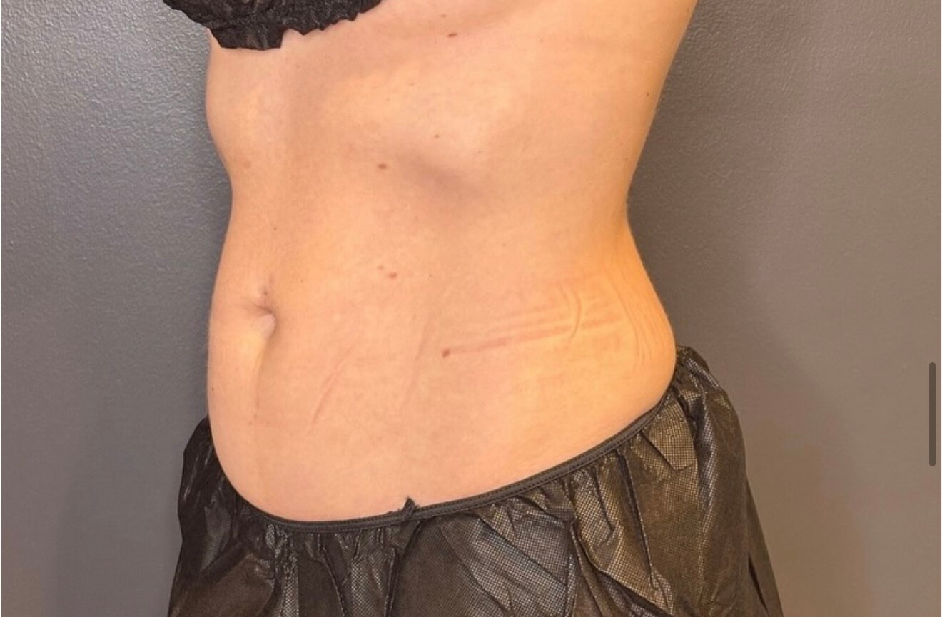 Sculpted Transformation After