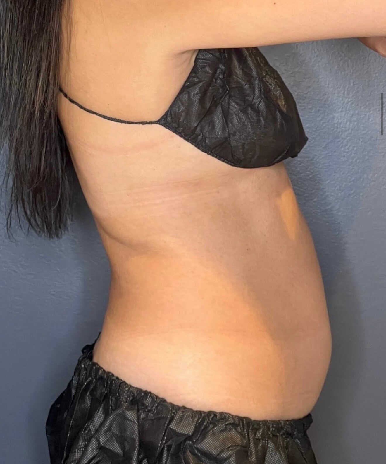 Back + Abs Transformation After