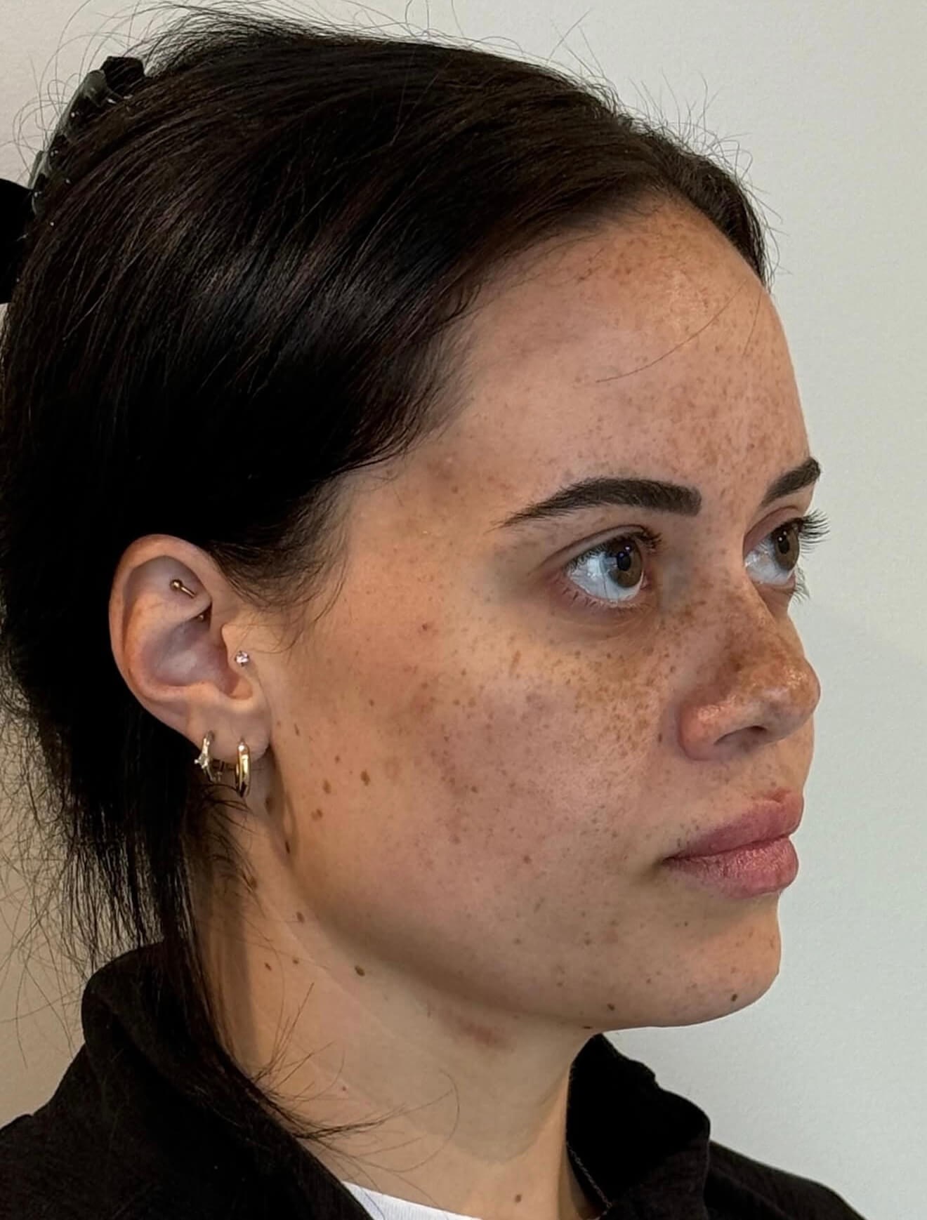 Sculpted Face Before & After Before