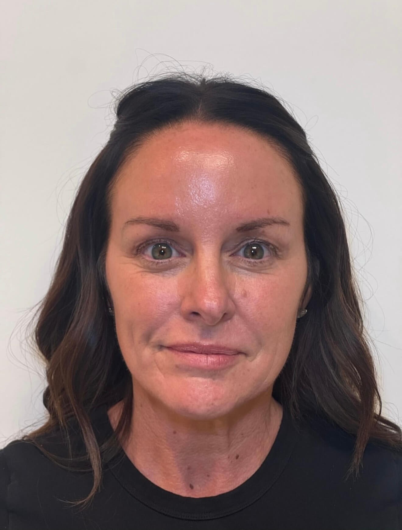 Lift & Contour Refresh Before