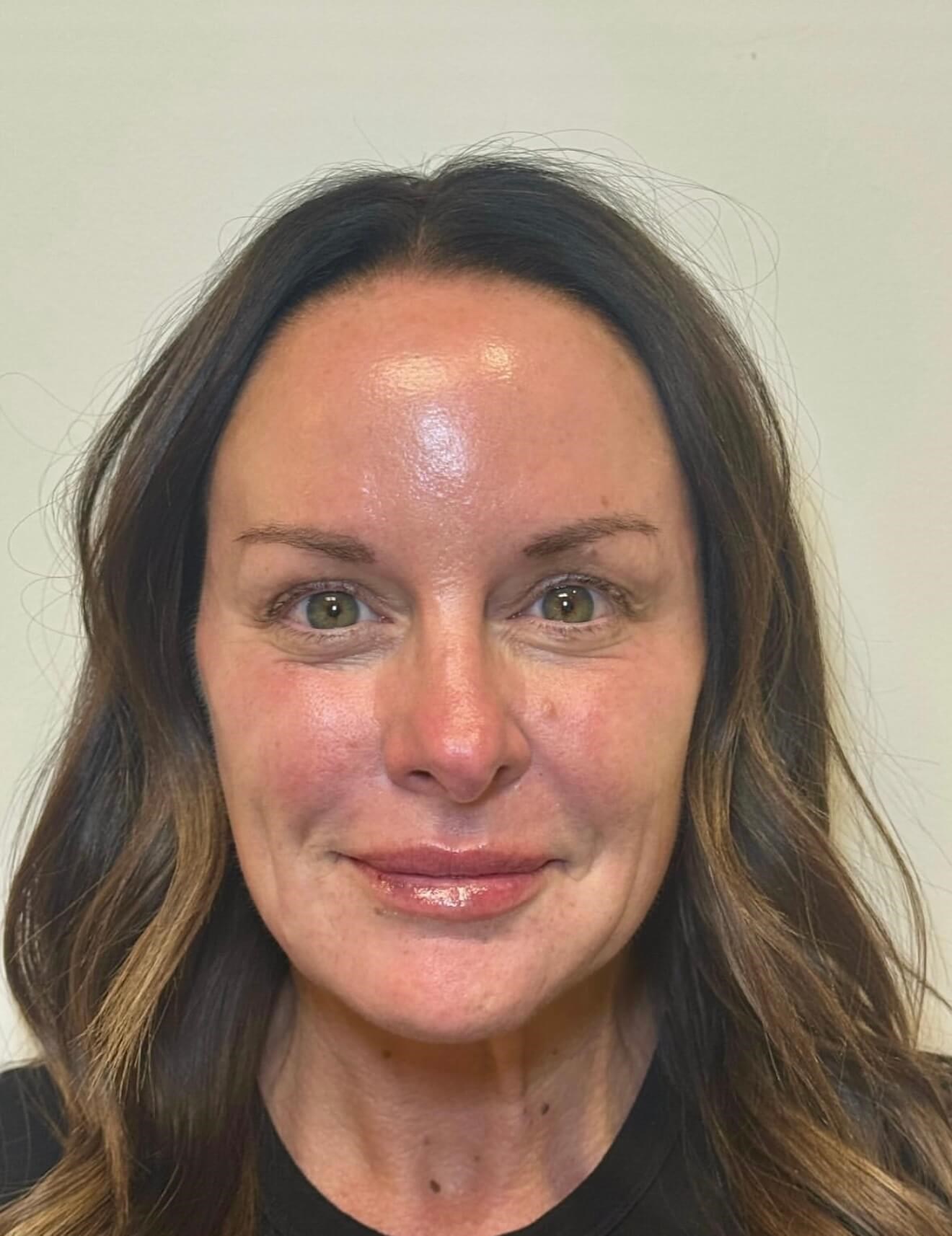 Lift & Contour Refresh After