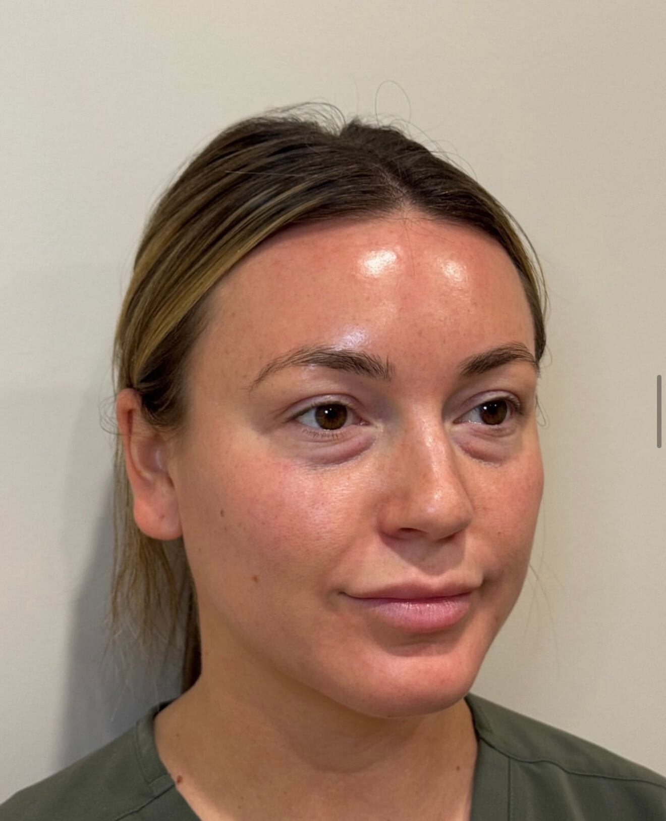 Refreshed Eye Rejuvenation Before