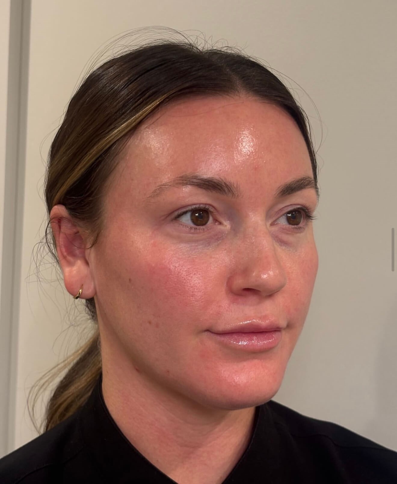 Refreshed Eye Rejuvenation After