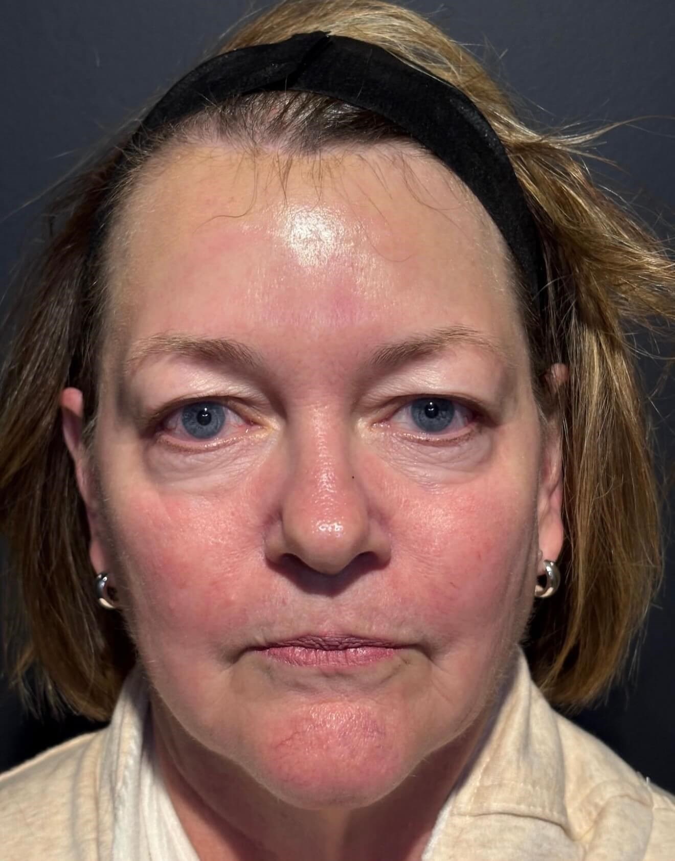 Advanced Skin Rejuvenation Before