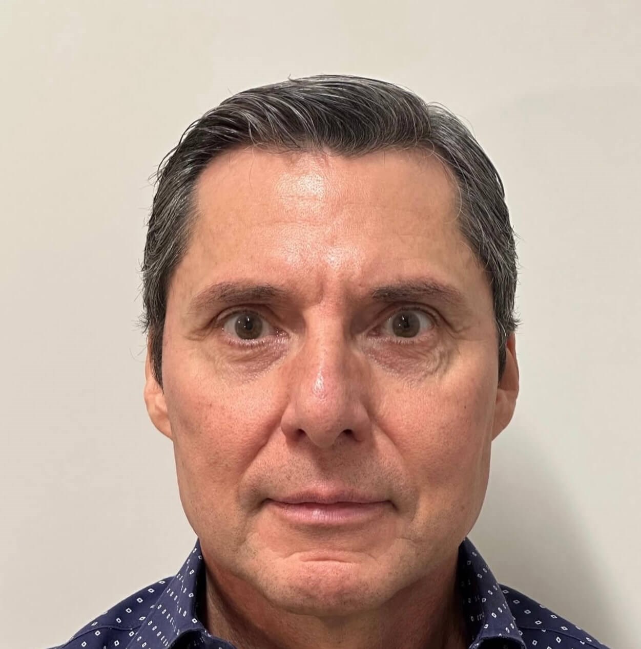 Sculptra Rejuvenation After