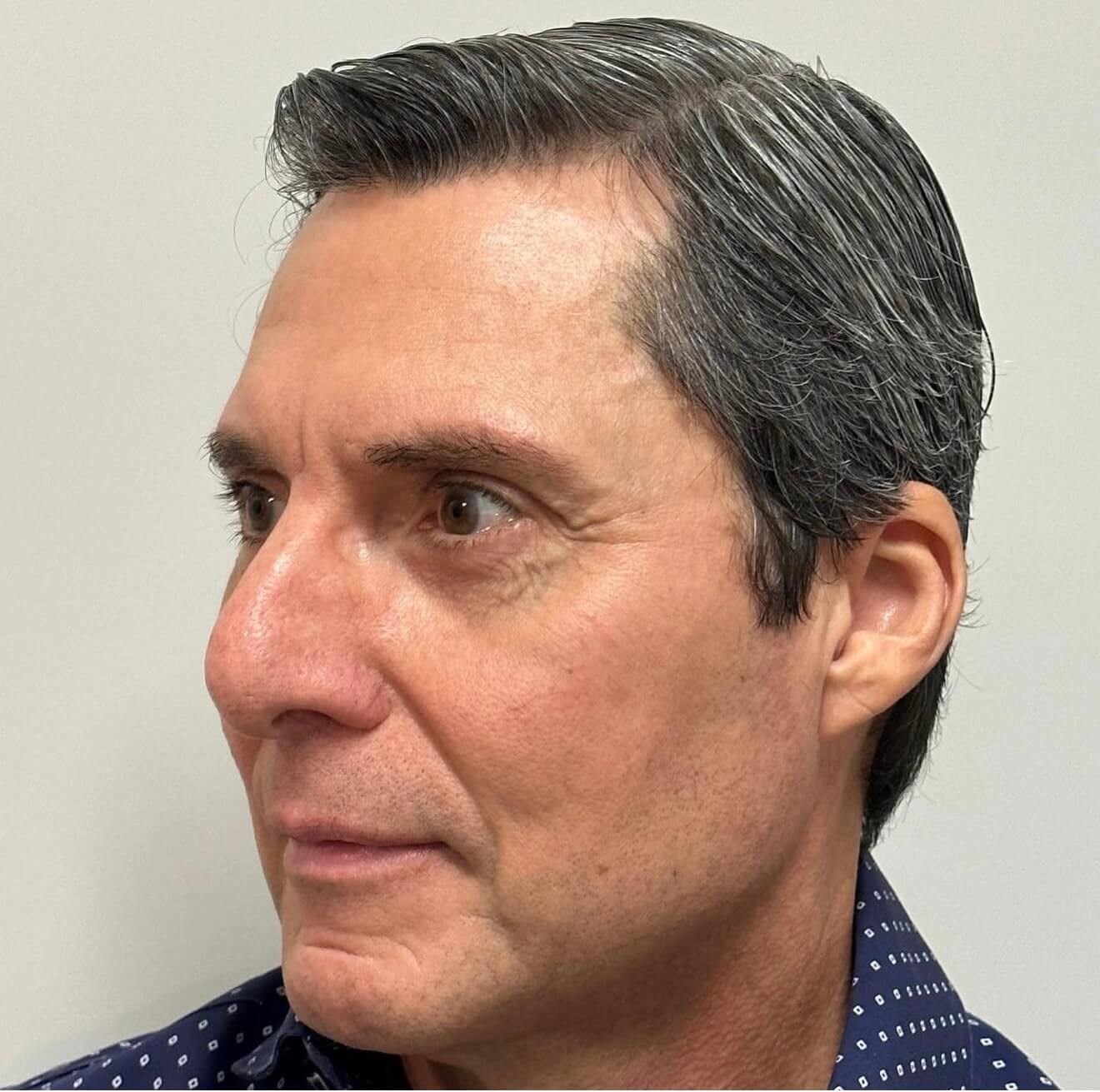 Sculptra Rejuvenation After