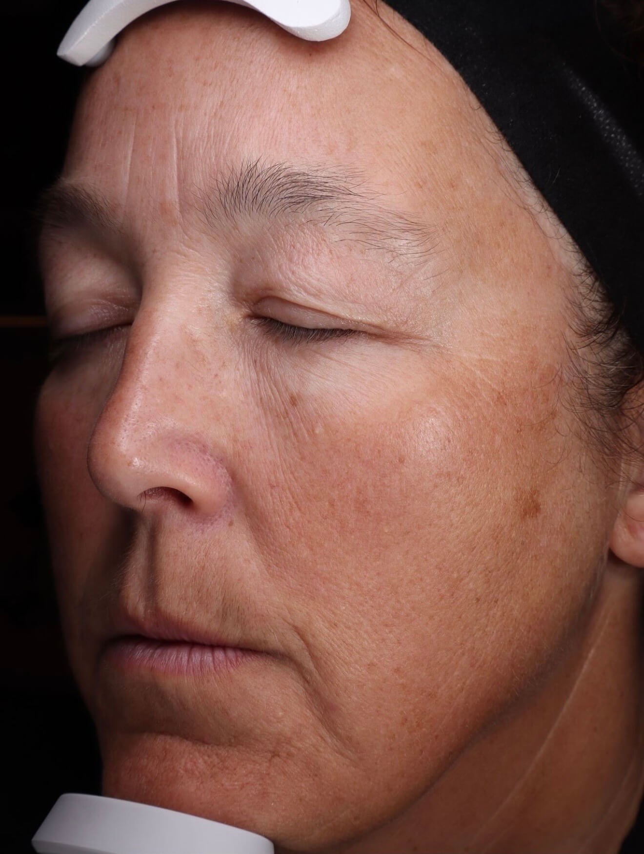 BBL Skin Renewal Before