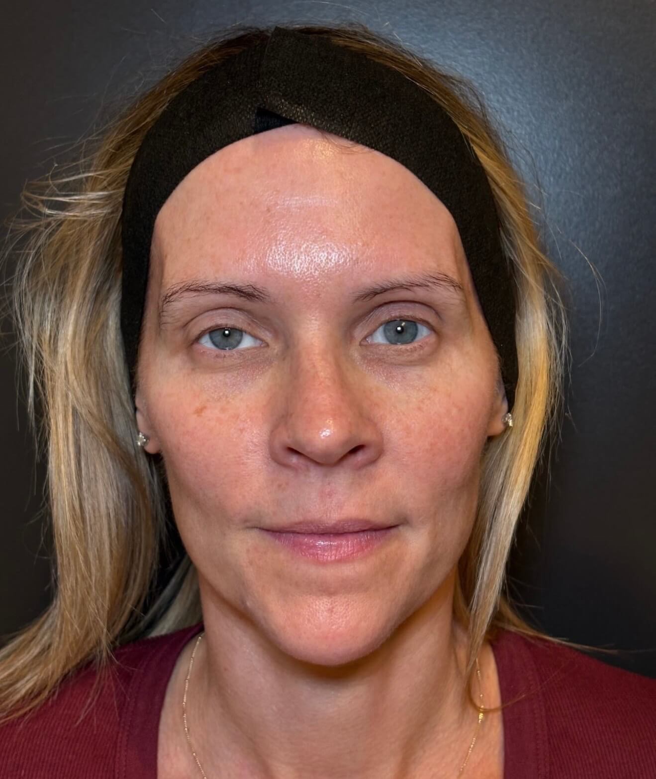 Moxi Elite Glow Before