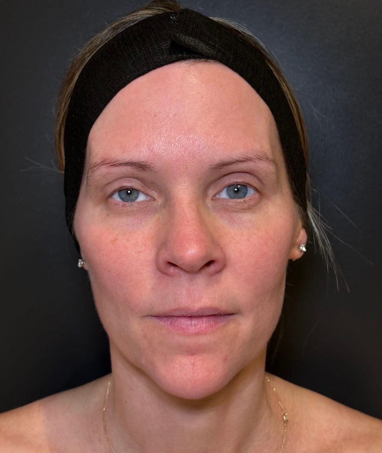 Moxi Elite Glow After