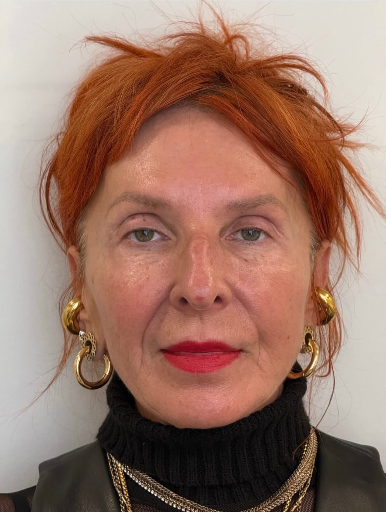 Full Face Renewal After