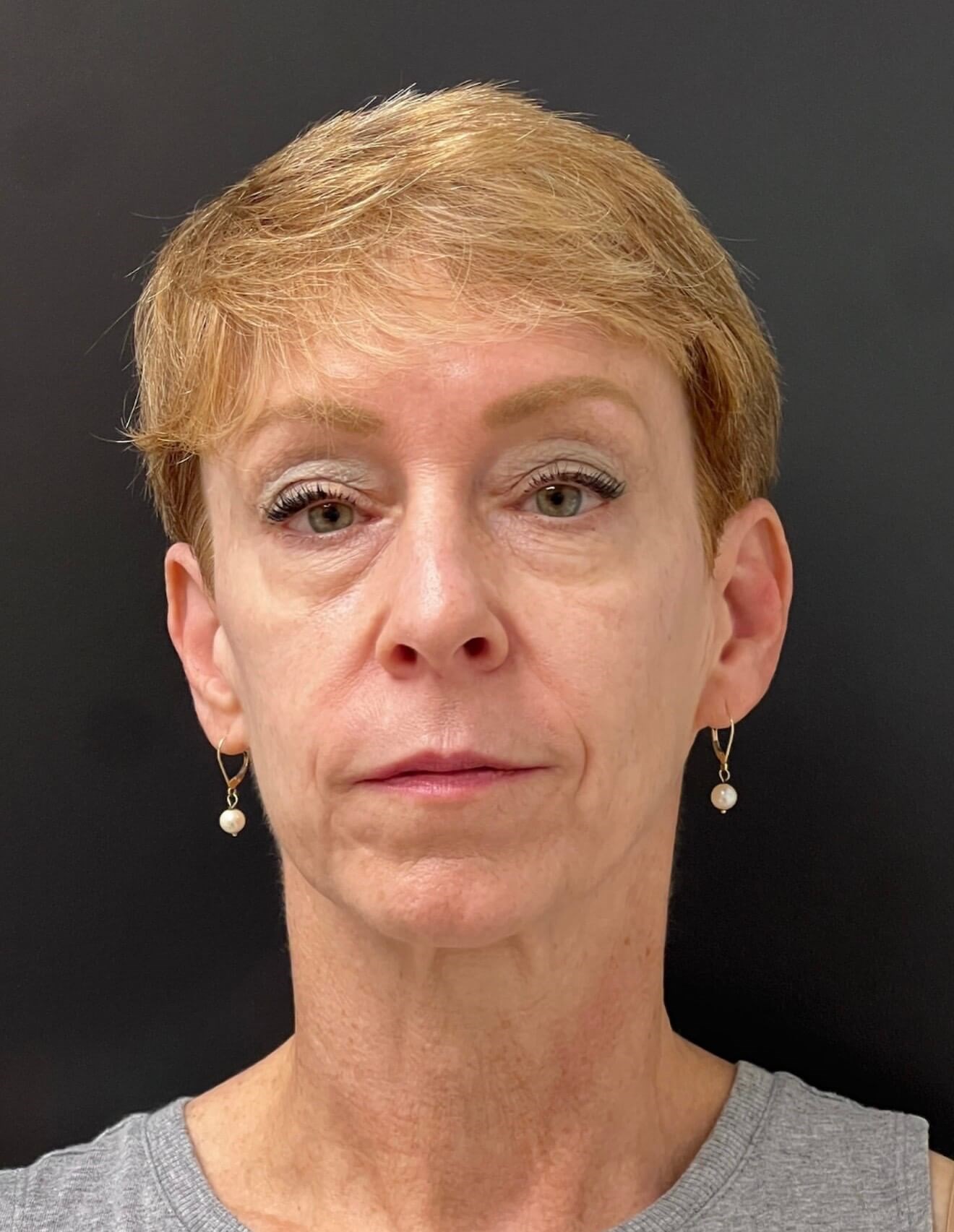 Full Face Refinement Before