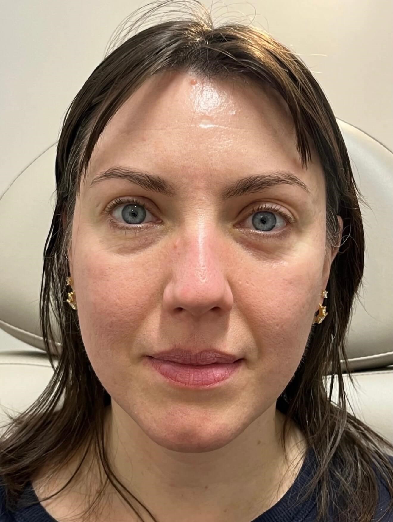 Full Face Skin Rejuvenation Before