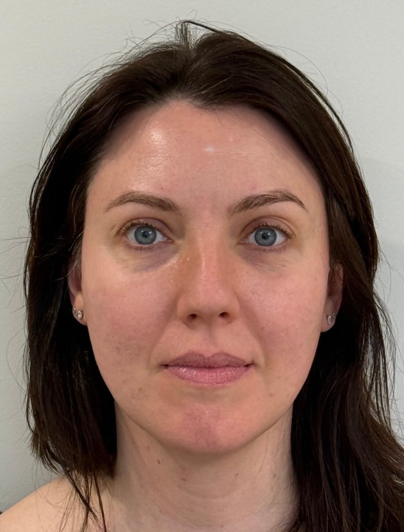 Full Face Skin Rejuvenation After