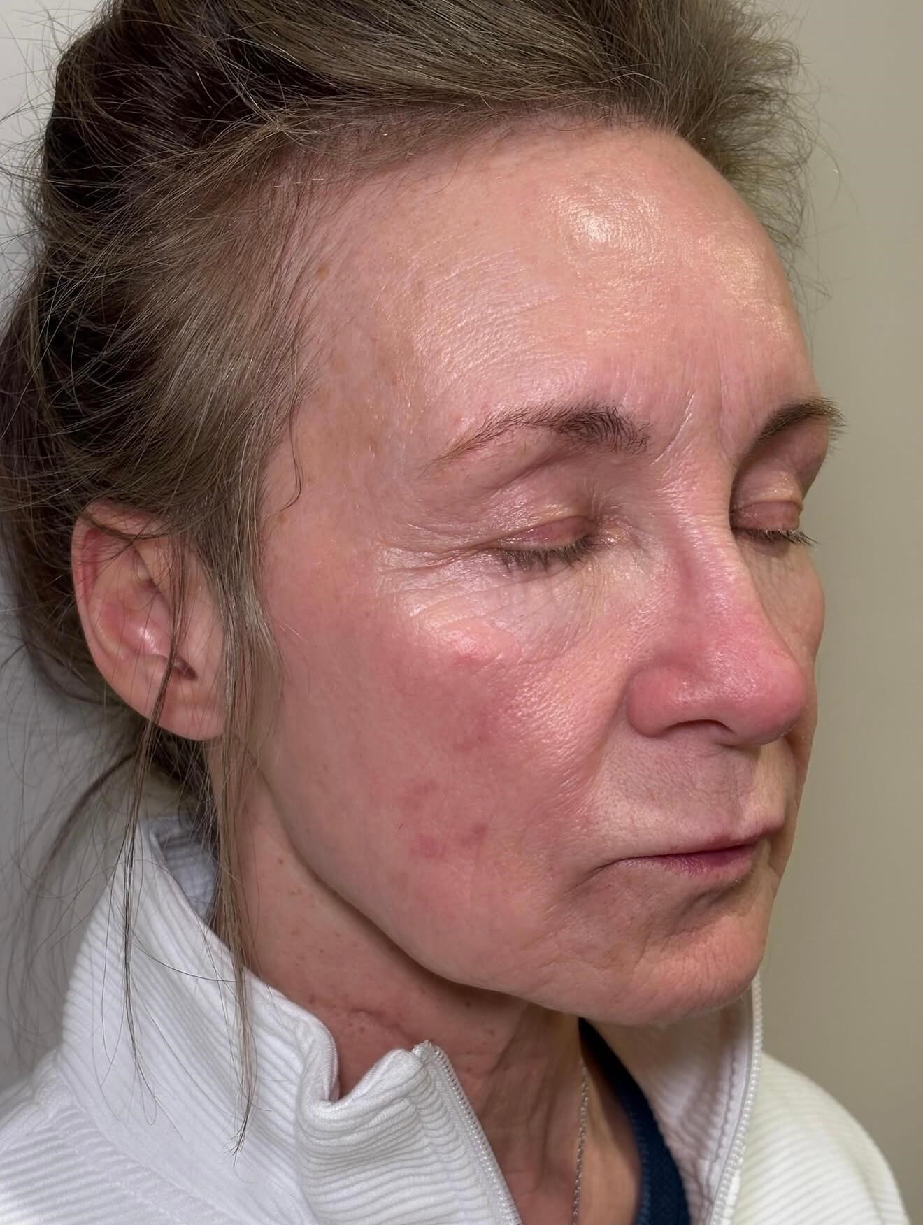 Skin Revival Before
