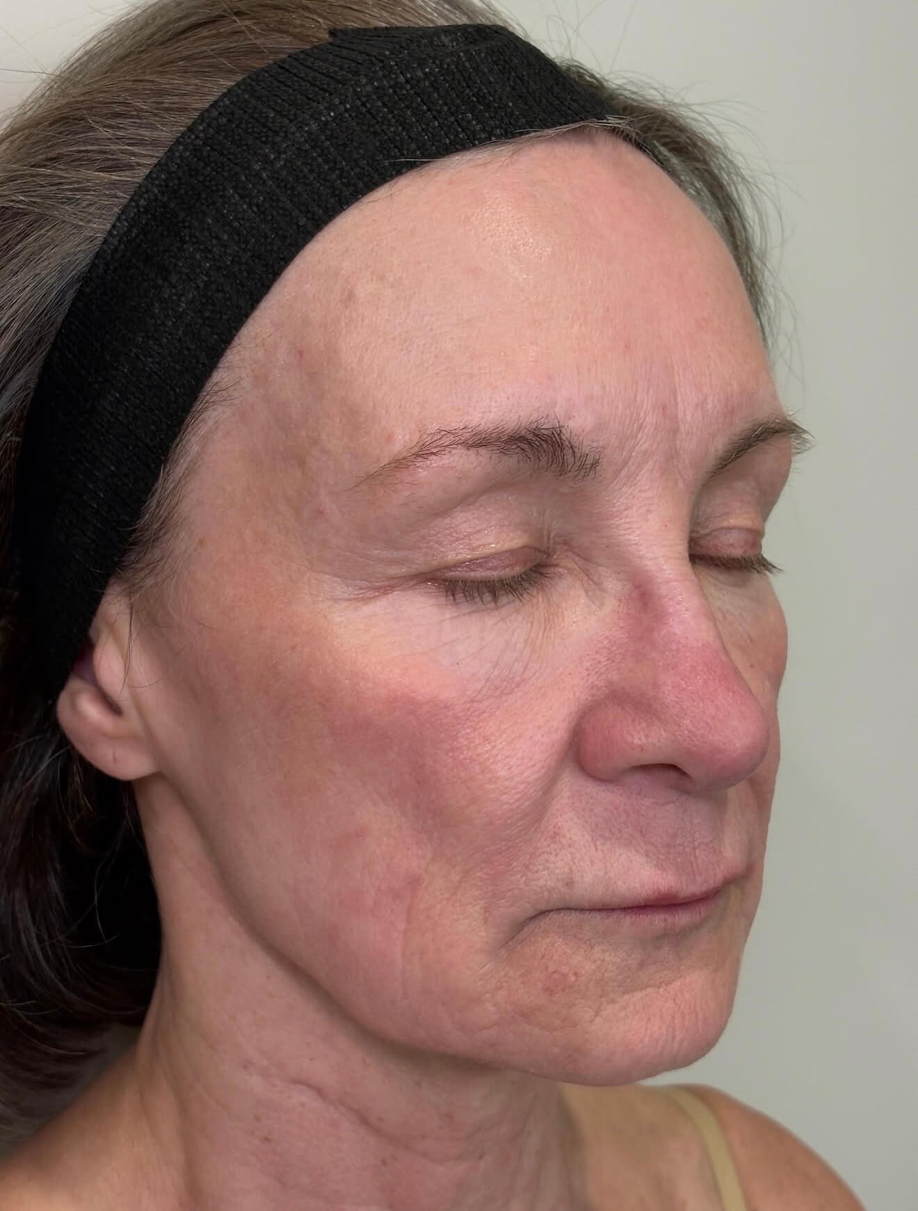 Skin Revival After
