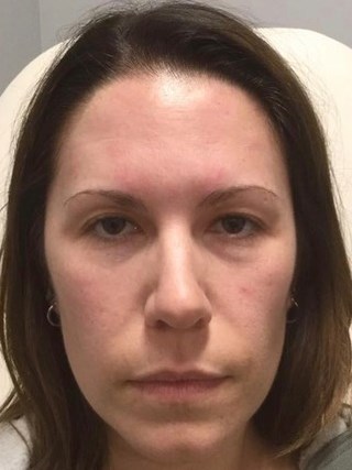 Nonsurgical Face Rejuvenation Before