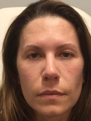 Nonsurgical Face Rejuvenation After