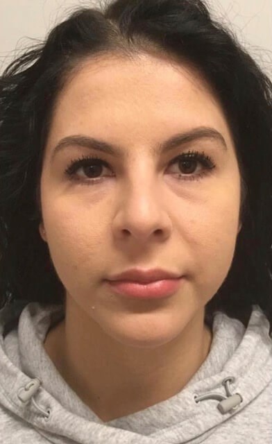 Female Facial Rejuvenation Before