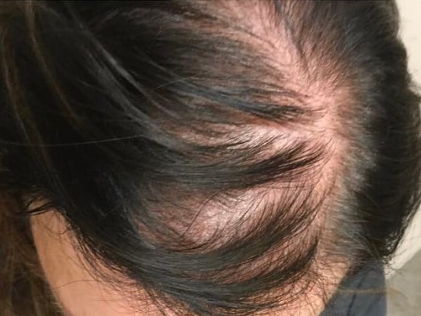 Female Hair Restoration PRP Before