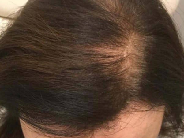 Female Hair Restoration PRP After