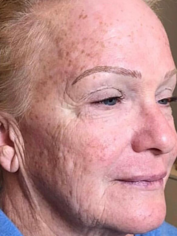 Forever Yound BBL Female Face Before