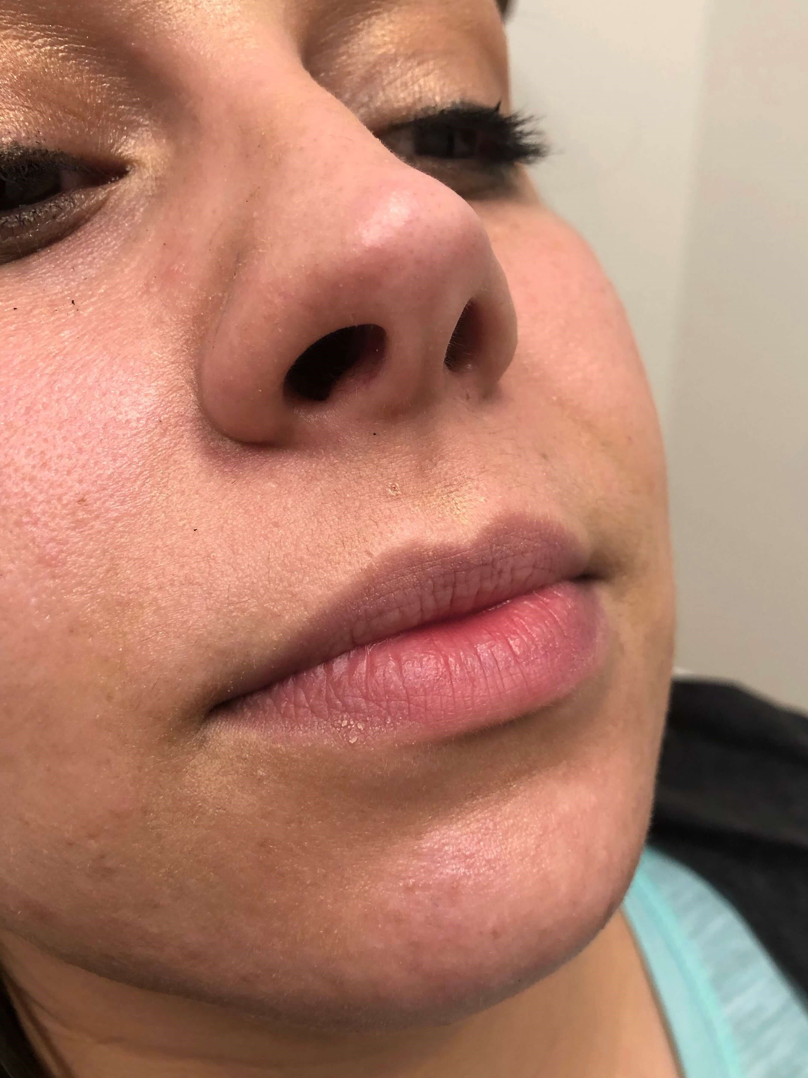 Female Juvederm lips Elmhurst Before