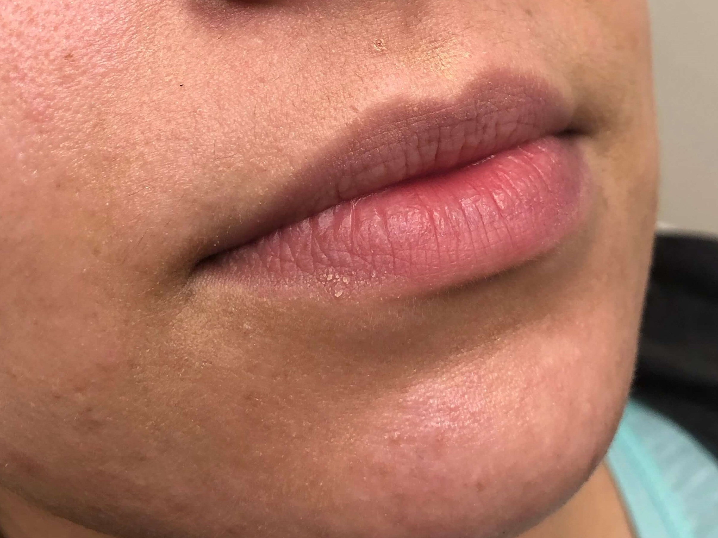 Female Juvederm lips Elmhurst Before