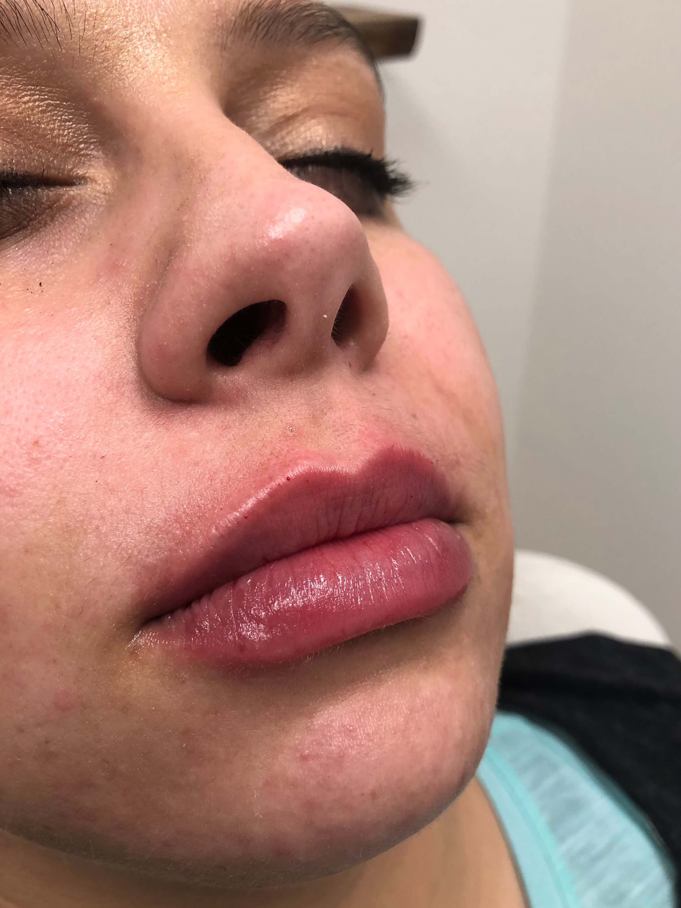 Female Juvederm lips Elmhurst After