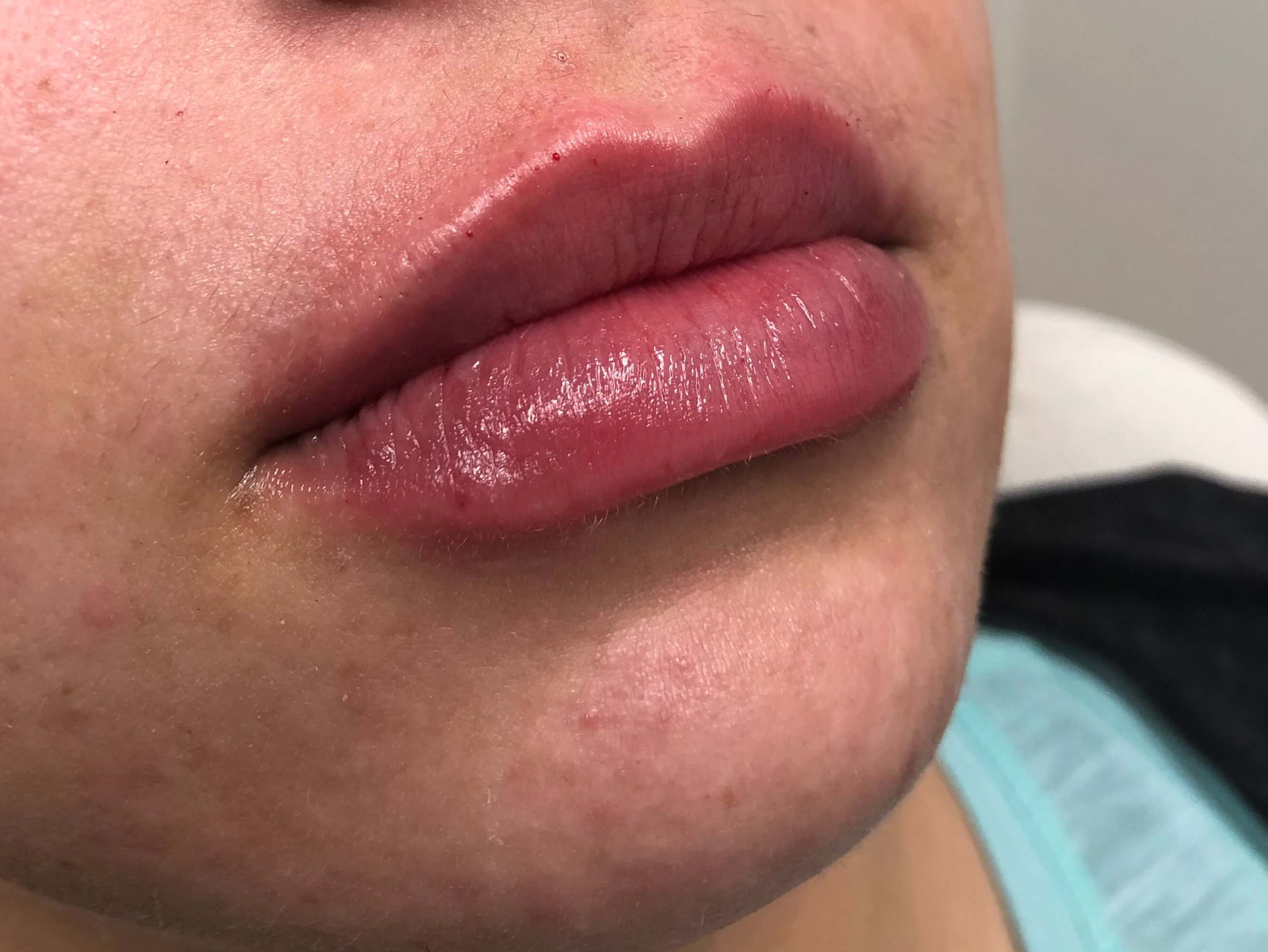 Female Juvederm lips Elmhurst After