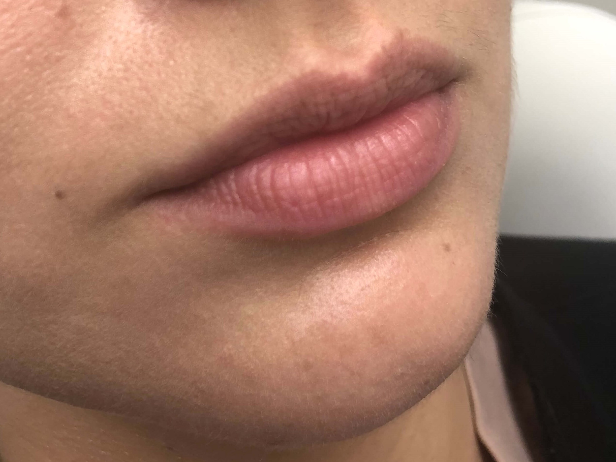 Juvederm Lip Enhancement Before