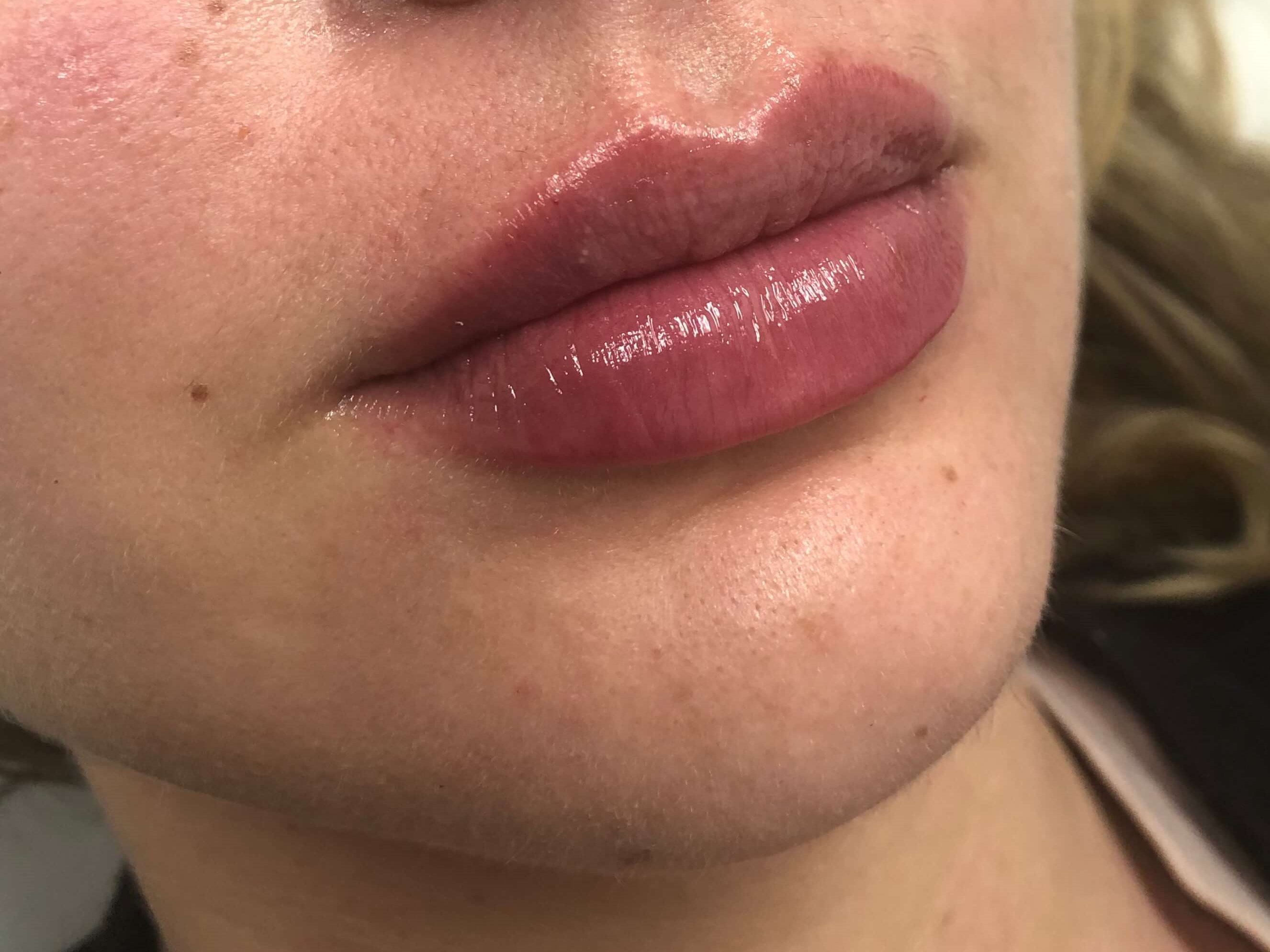 Juvederm Lip Enhancement After