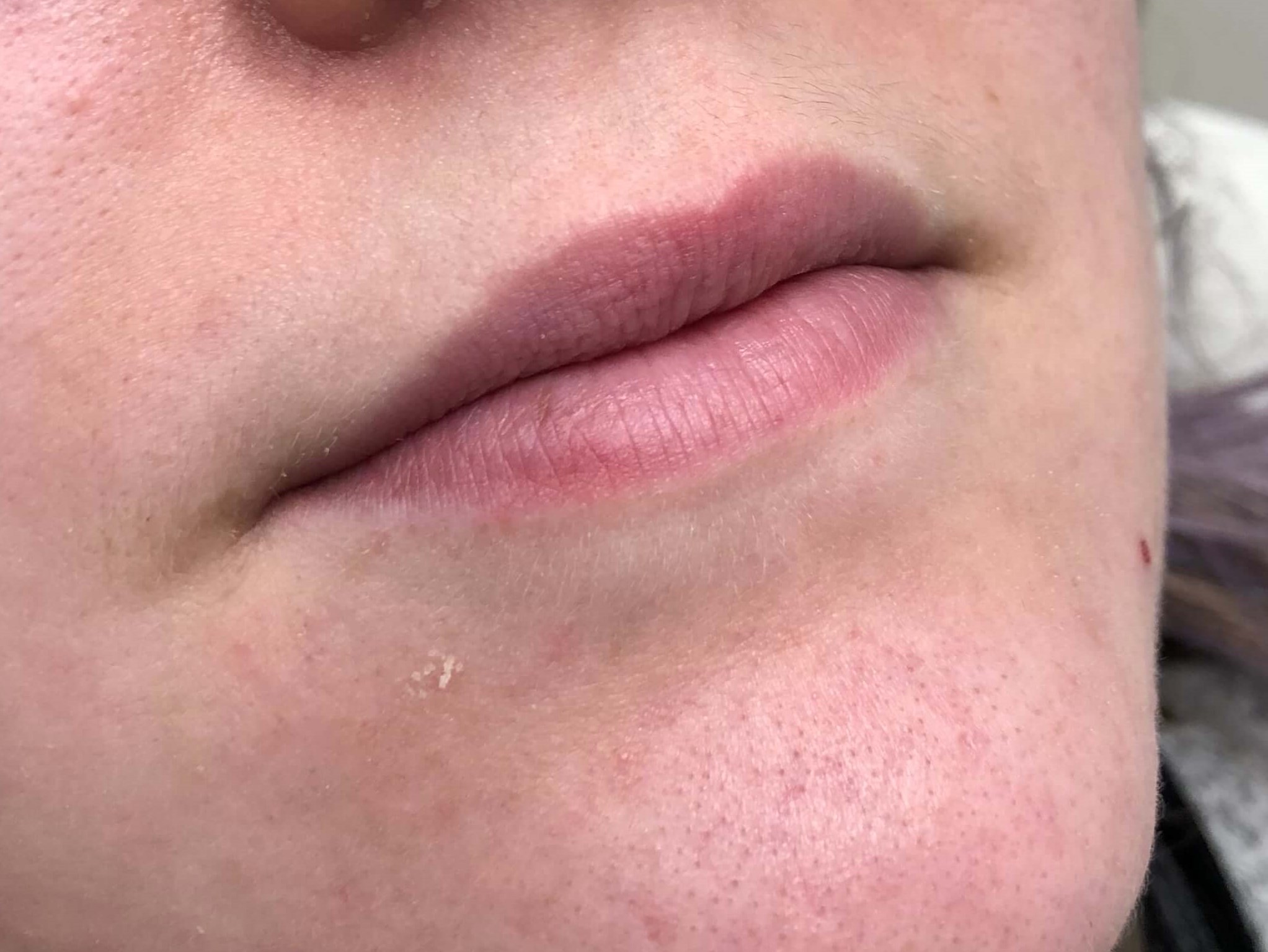 Juvederm Lip Enhancement Before
