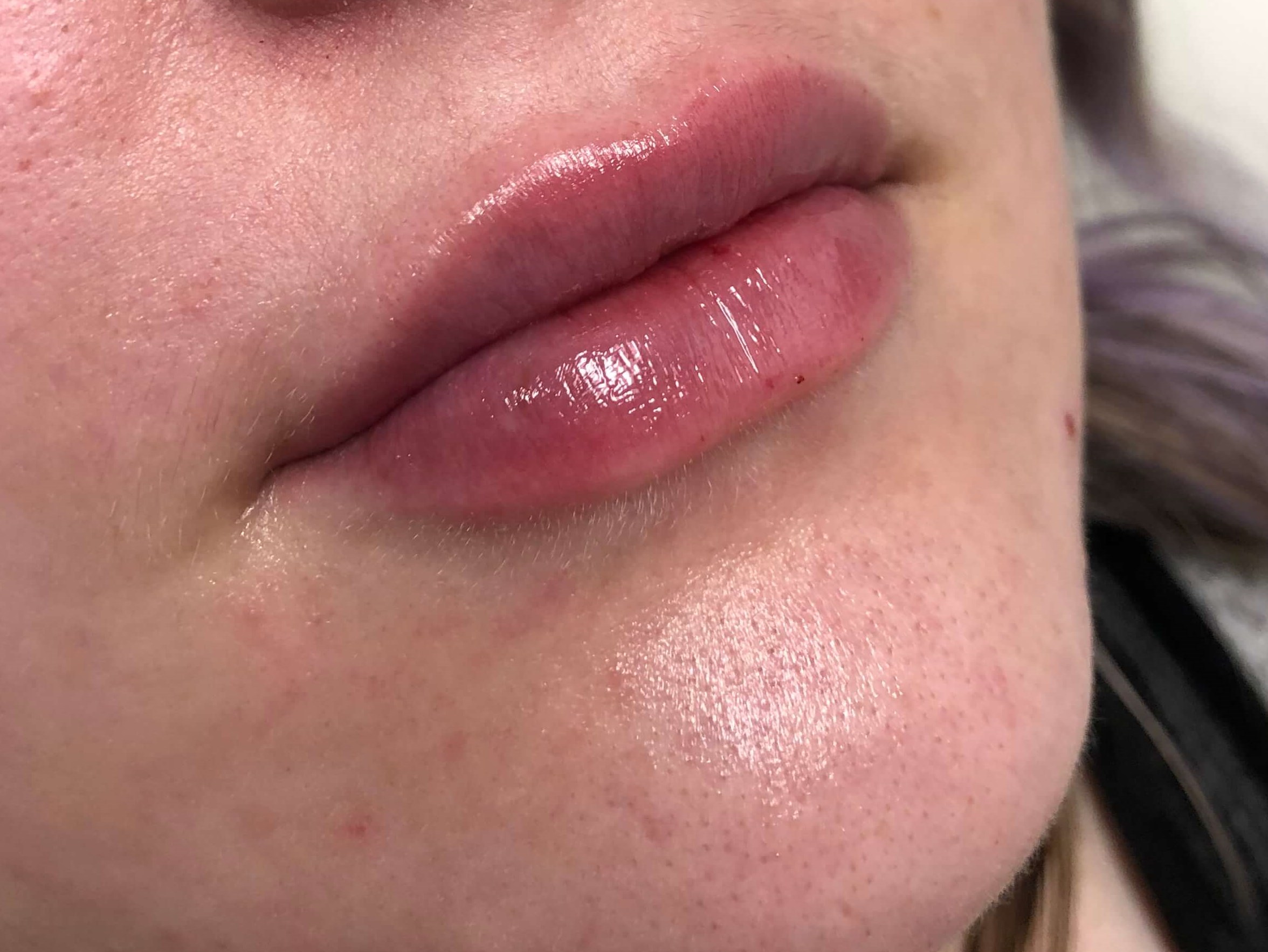 Juvederm Lip Enhancement After