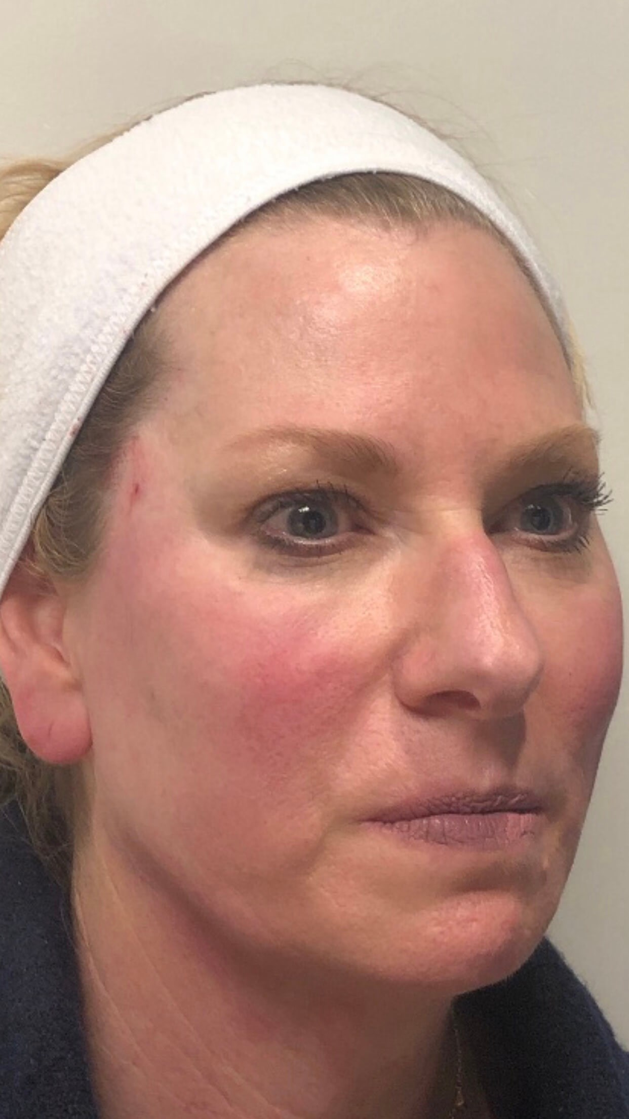 PDO Thread Face Lift After