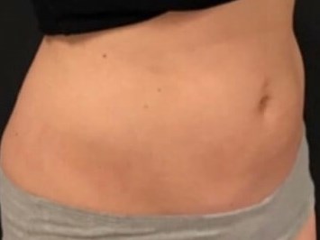 Female abdomen Cool sculpting After
