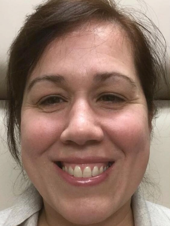 Gummy Smile Before