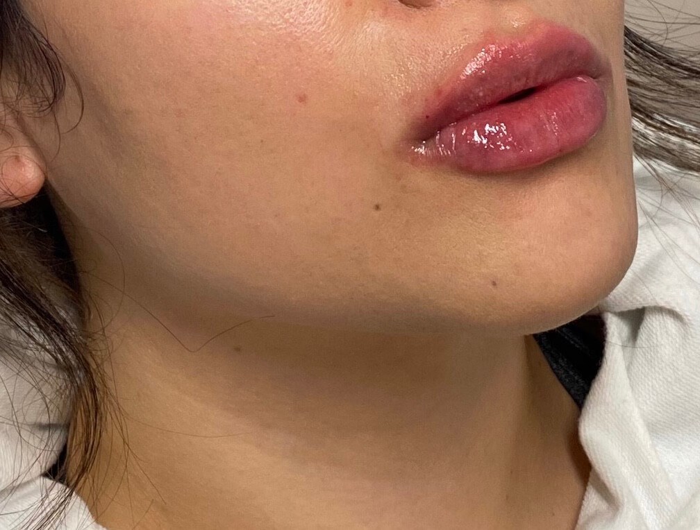 Juvederm lip enhancement After
