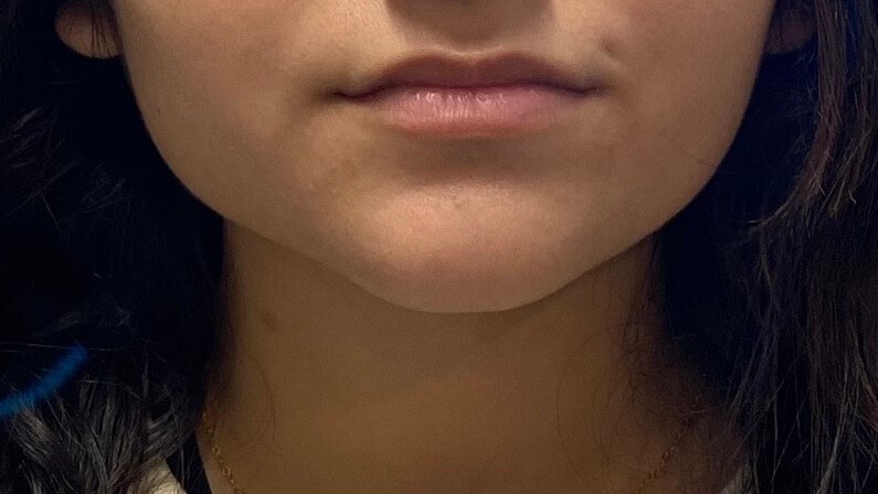 Volbella Lips Before