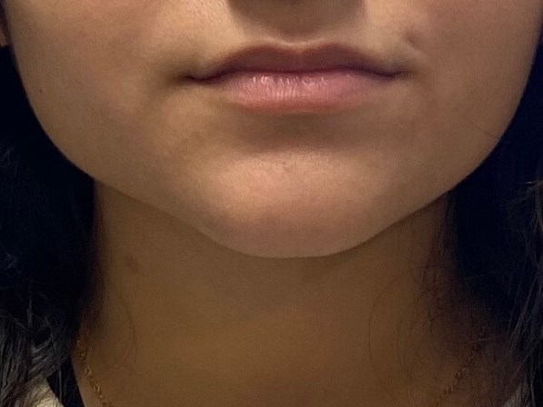 Volbella Lips Before