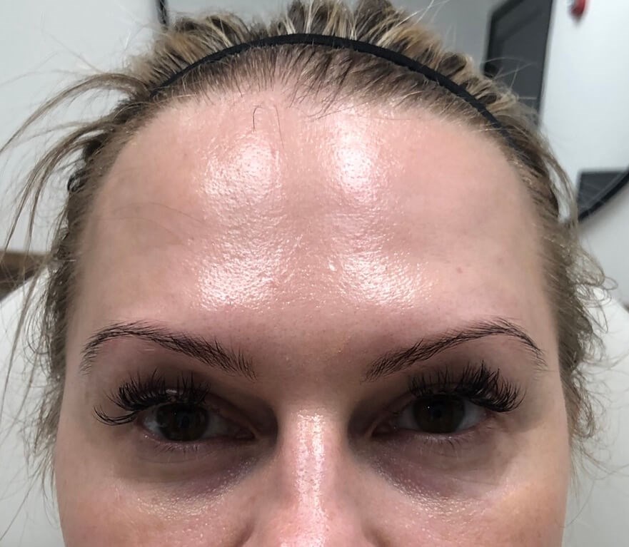 Juvederm Tear Trough Before