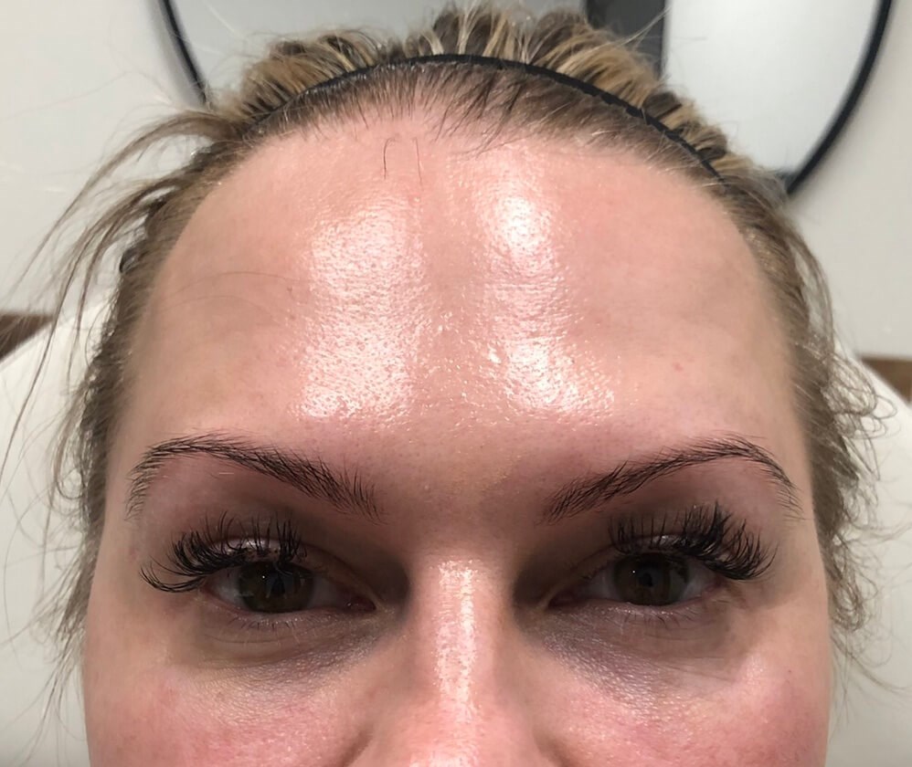 Juvederm Tear Trough After