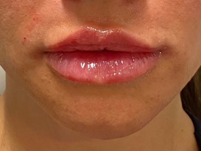 Restylane Kysse lips female After