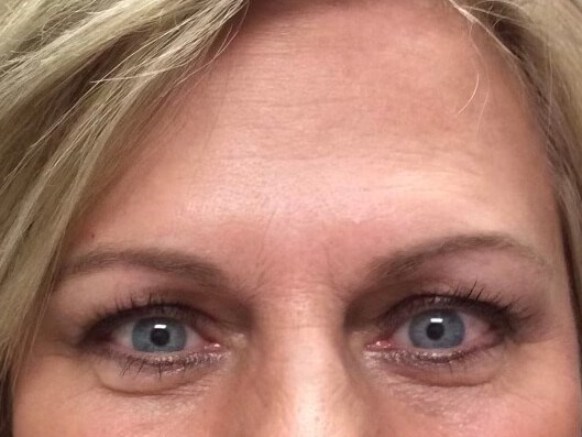 Juvederm & Botox After