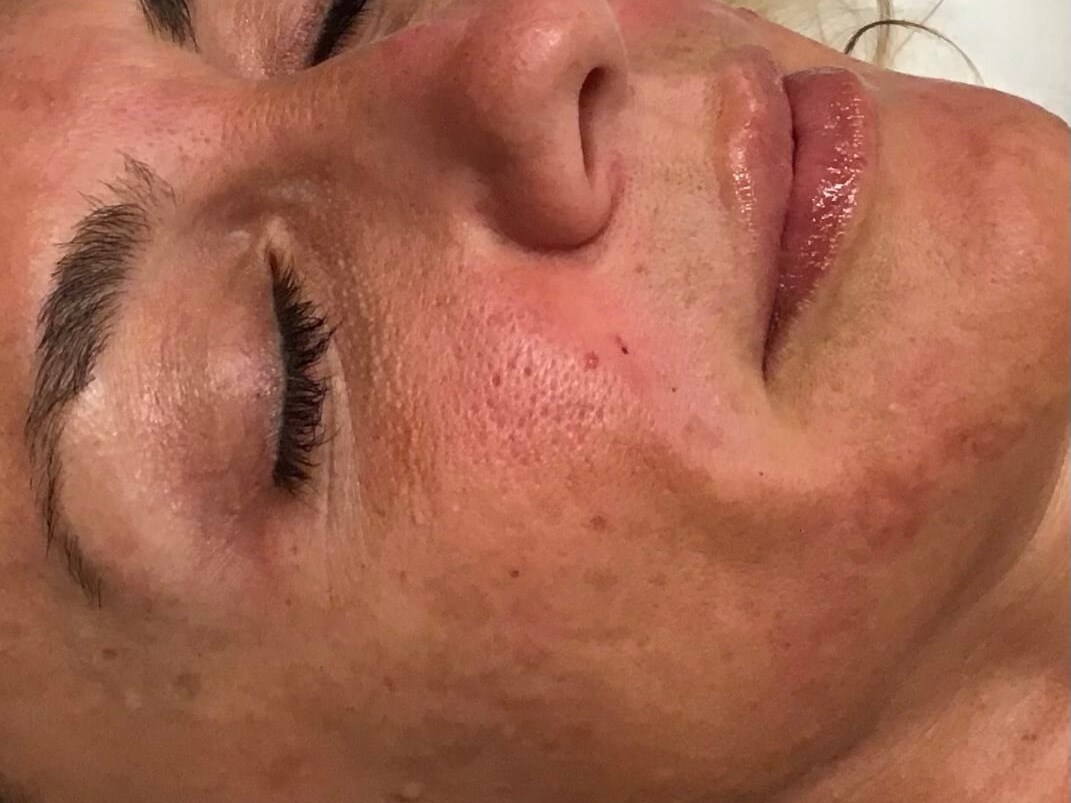 Microneedling & Laser series Before