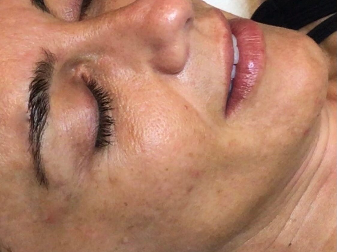 Microneedling & Laser series After